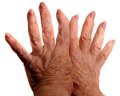 The impact of arthritis