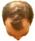 Hair Loss
