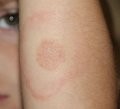 Health and Safety Information on Lyme Disease